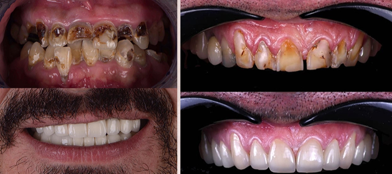 Best Full Mouth Rehabilitation  Sasane Nagar
